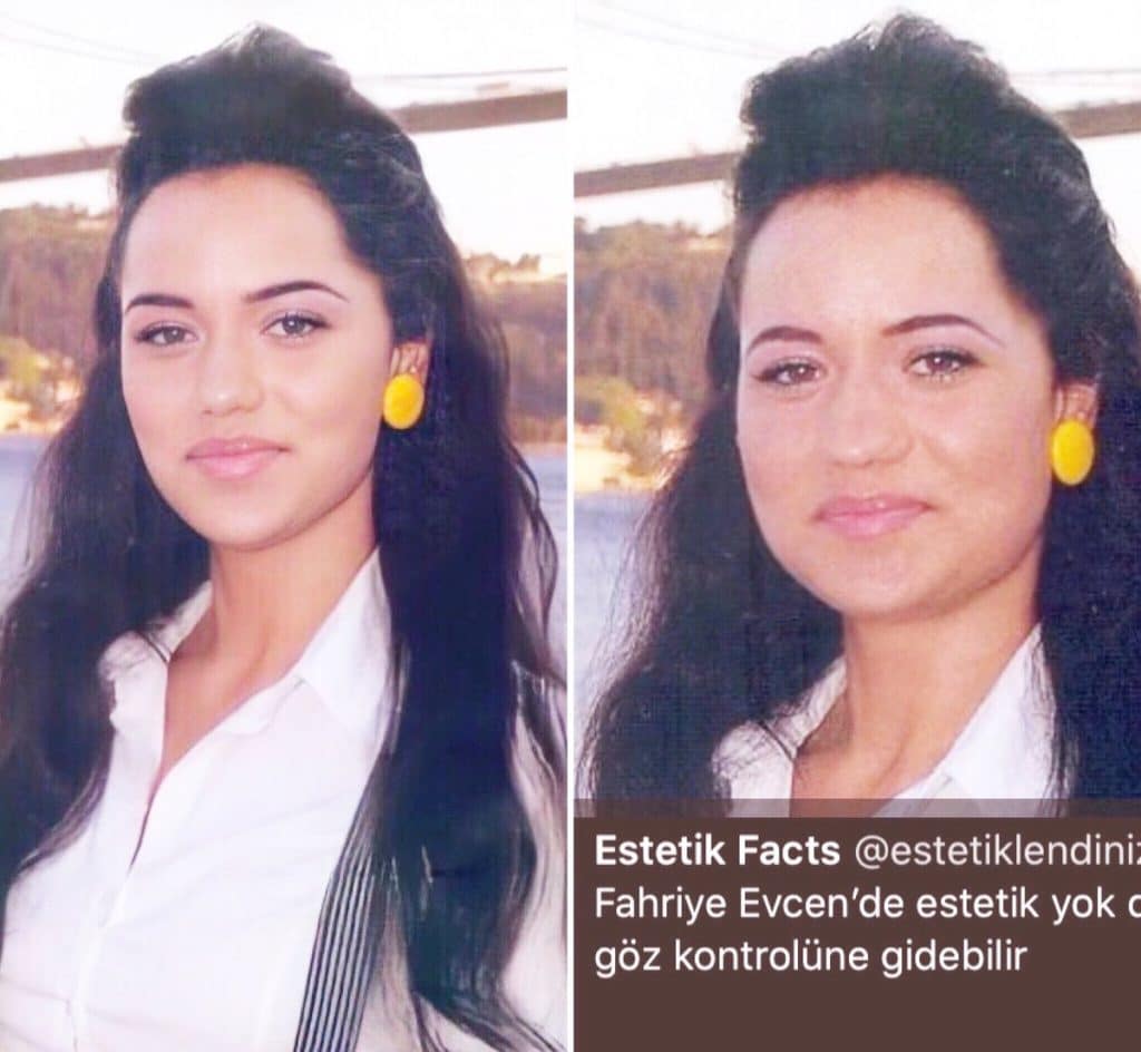 Fahriye Evcen estetik
